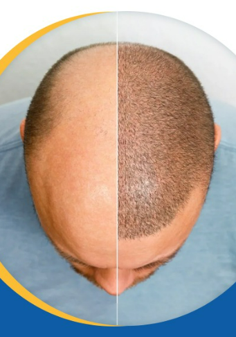 Best Hair Transplant Doctor In Nepal