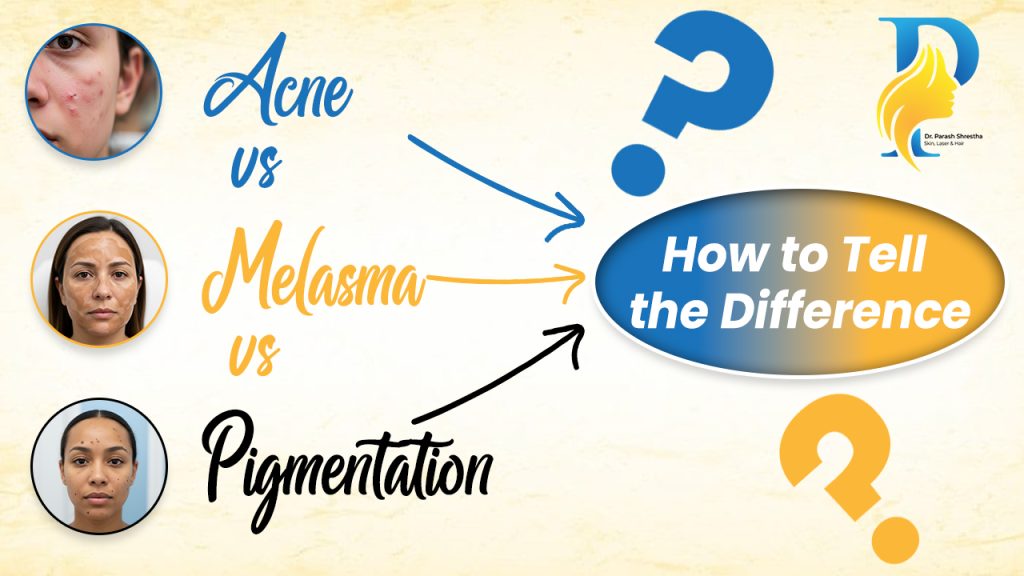 Acne vs Melasma vs Pigmentation