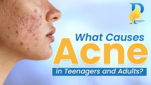 what causes acne