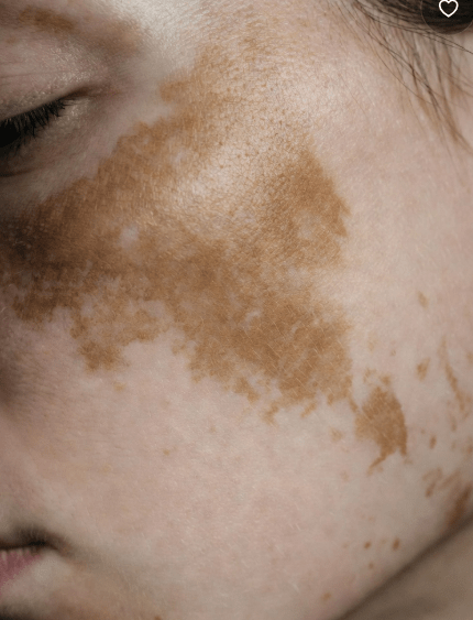 pigmentation 