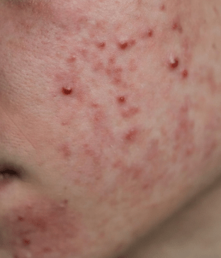 what causes acne