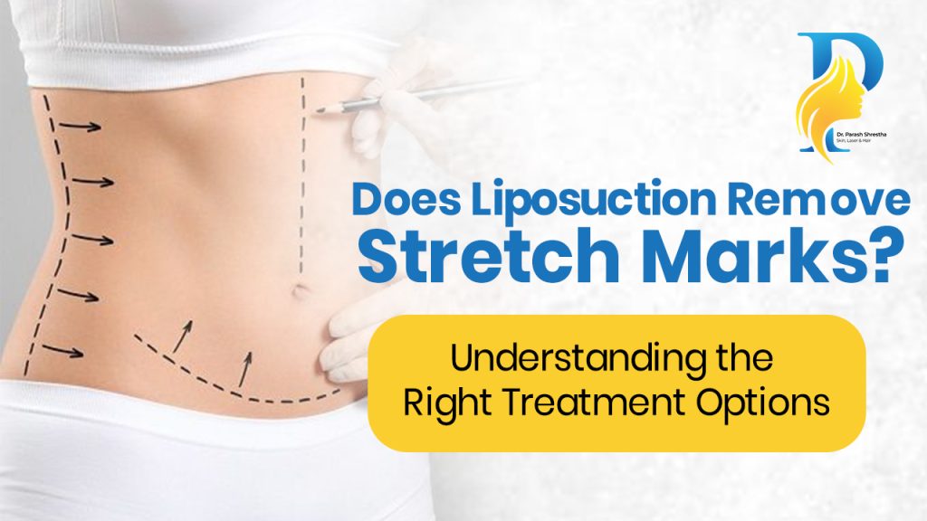 Does Liposuction Remove Stretch Marks